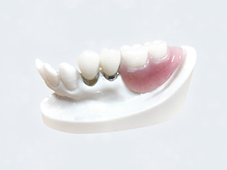 高い安全性と信頼性を誇るコーヌス義歯で、噛める喜びを取り戻します。