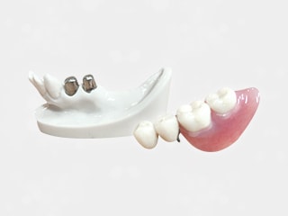 義歯の治療